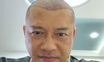 Anang Hermansyah Lakukan Transplantasi Rambut, Bagaimana Menurut Islam